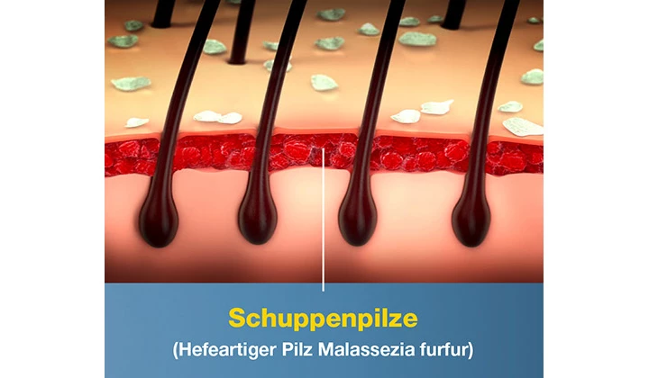Malassezia furfur auf der Kopfhaut Malassezia furfur auf der Kopfhaut